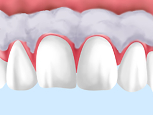 歯ぐきも美しく〜ガムピーリング〜