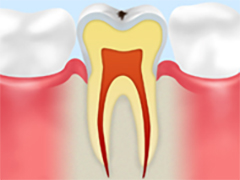 レベル1CO：初期の虫歯