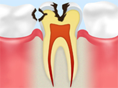 レベル3C2：象牙質の虫歯