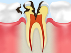 レベル4C3：神経に達した虫歯
