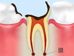 レベル5C4：歯根に達した虫歯