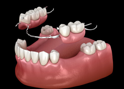 他の歯への影響