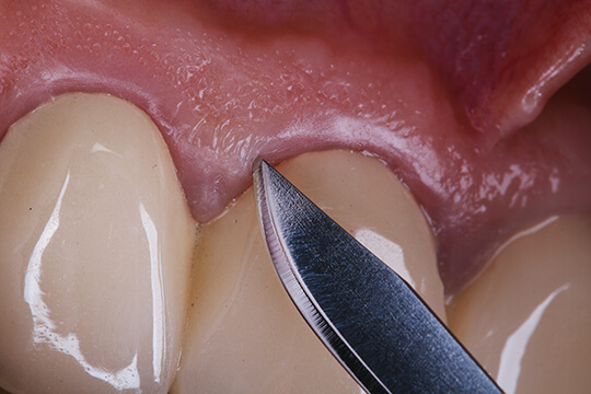 3. 歯周外科手術